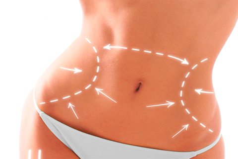 Abdominoplastia